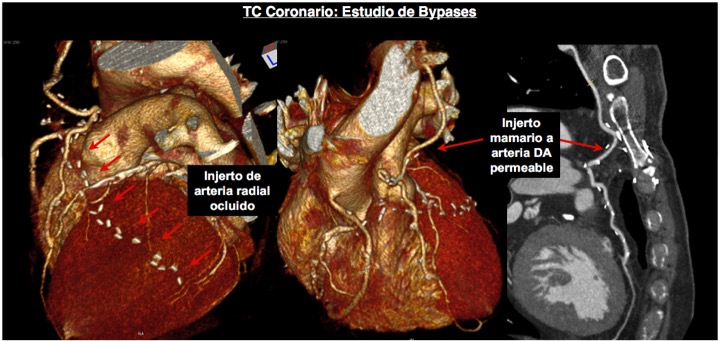 C.14. TC estudio de bypases