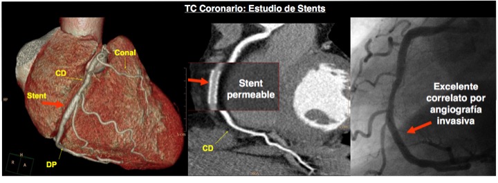 C.14. TC estudio de stents