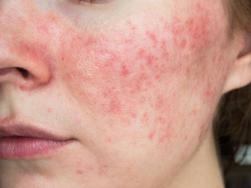 rosacea y acne