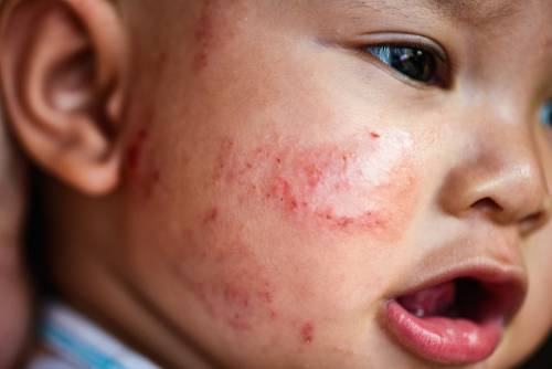 rosacea