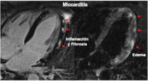 C.15. Foto Miocarditis