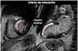 C.15. Foto Infarto