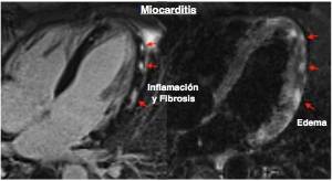 C.15. Foto Miocarditis