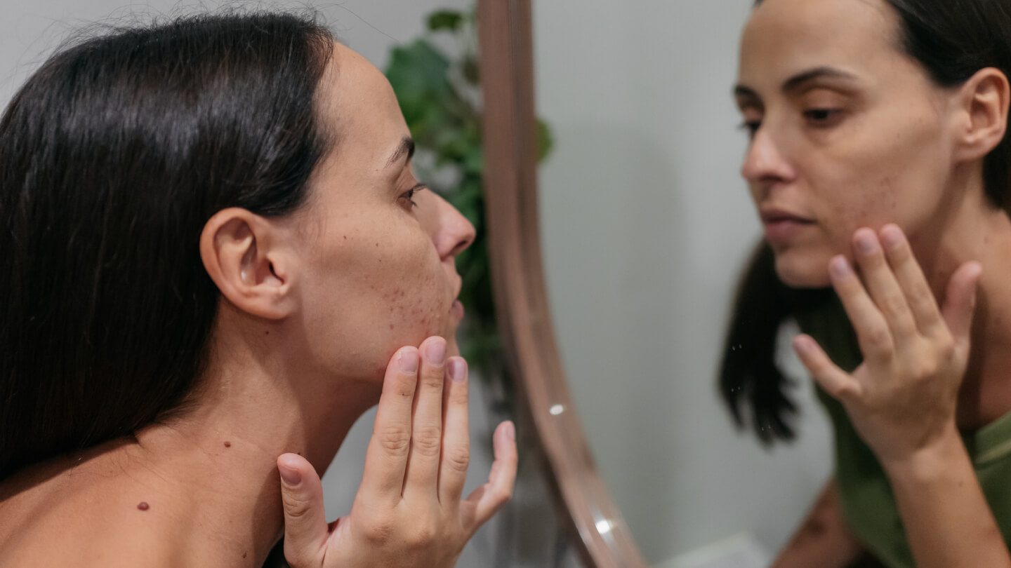 acne-despues-25-causas-soluciones